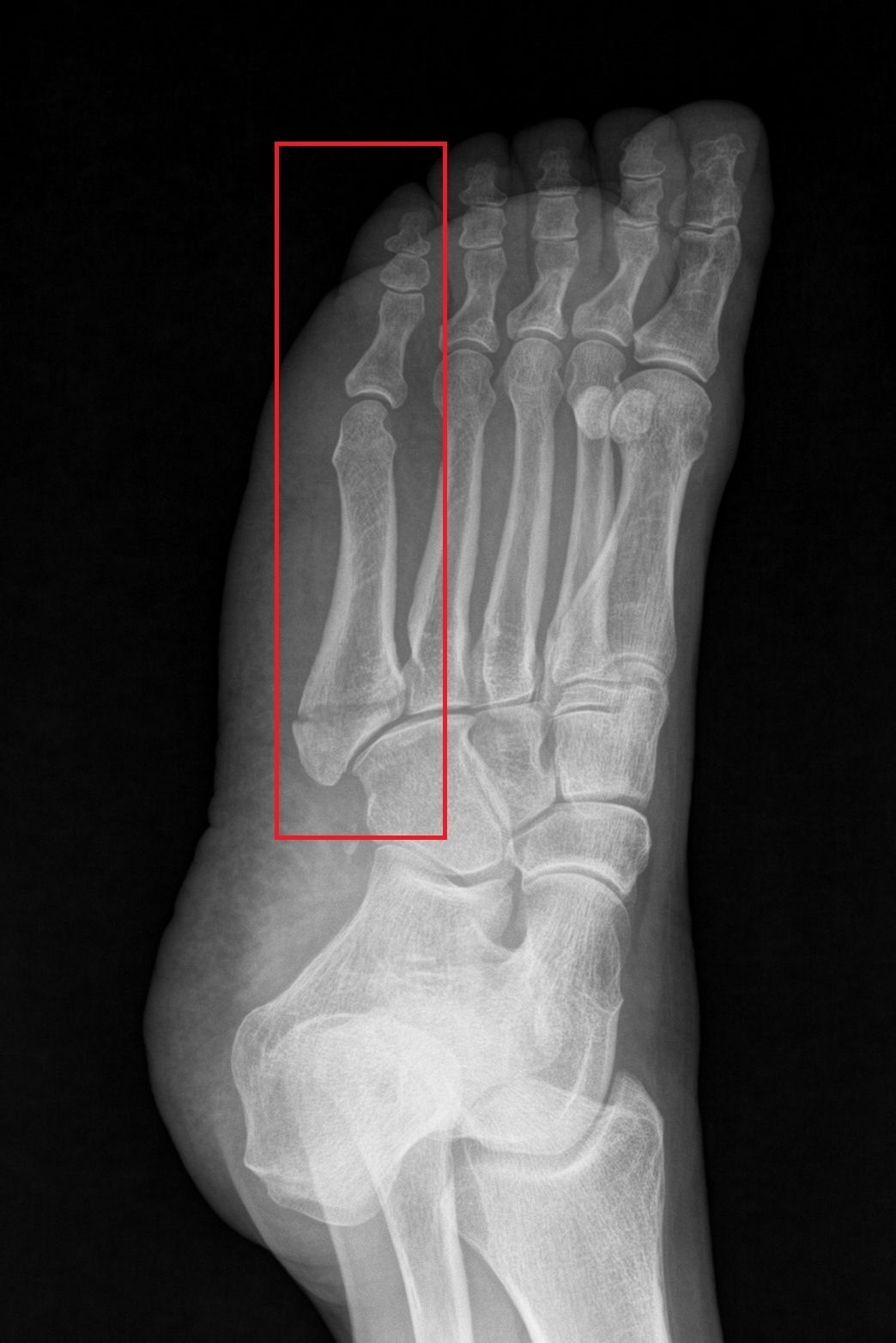 5th Metatarsal Fractures South Jersey Podiatrist South Jersey Foot